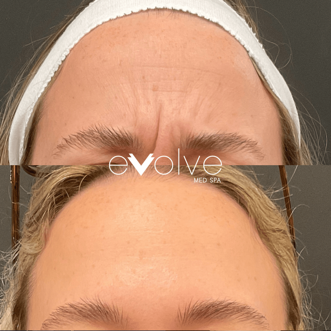Botox before and after β Frown Lines(11's), Evolve Med Spa Jersey City, NJ