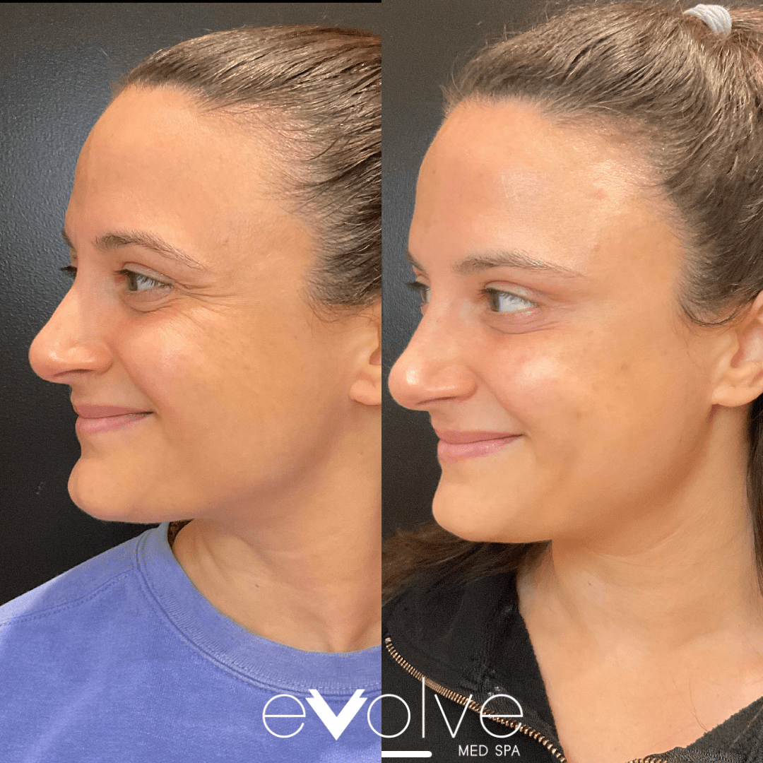 Botox before and after β Crow's Feet, Evolve Med Spa Hoboken, NJ