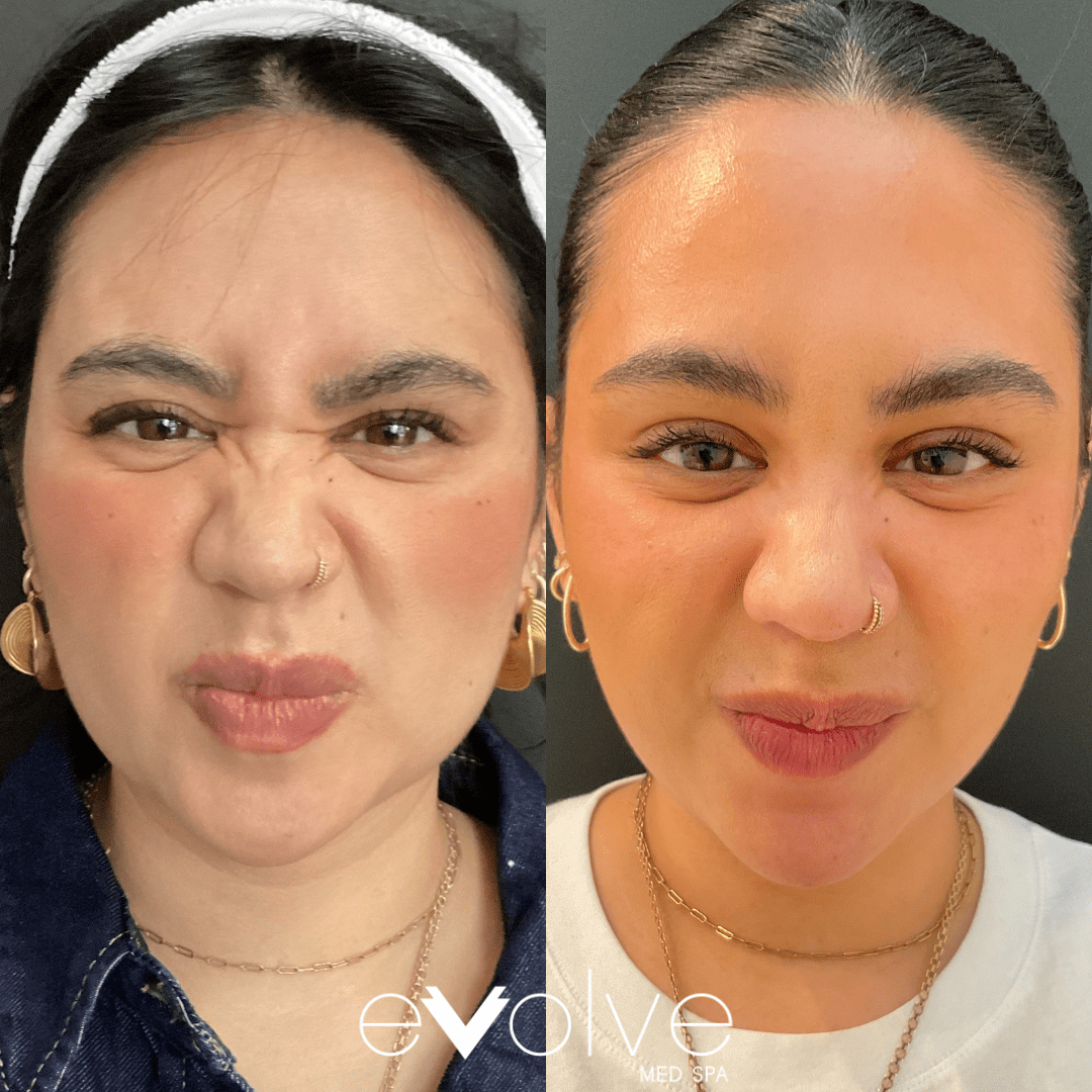 Botox before and after β Bunny Lines, Frown Lines(11's), Evolve Med Spa Hoboken, NJ