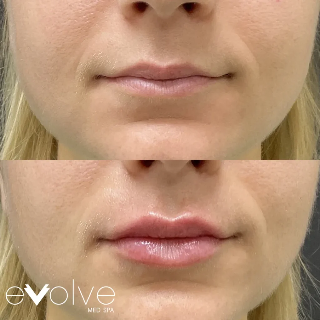 Lip filler before and after with Versa, Evolve Med Spa Bel Air, MD, ages 20-30