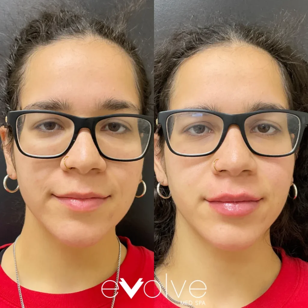 Lip filler before and after with Versa, Evolve Med Spa Bel Air, MD, ages 20-30