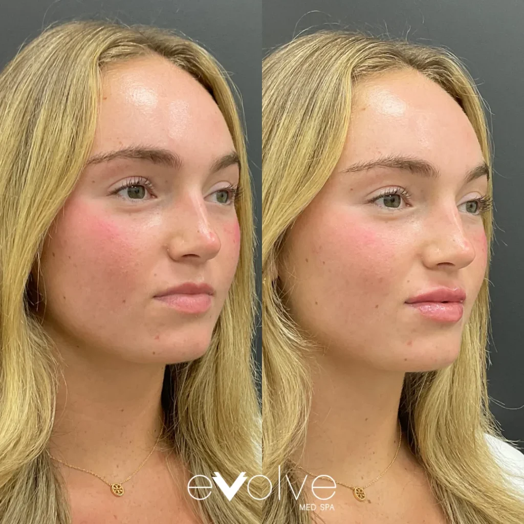 Lip filler before and after with Versa, Evolve Med Spa Bridgewater, NJ, ages 20-30