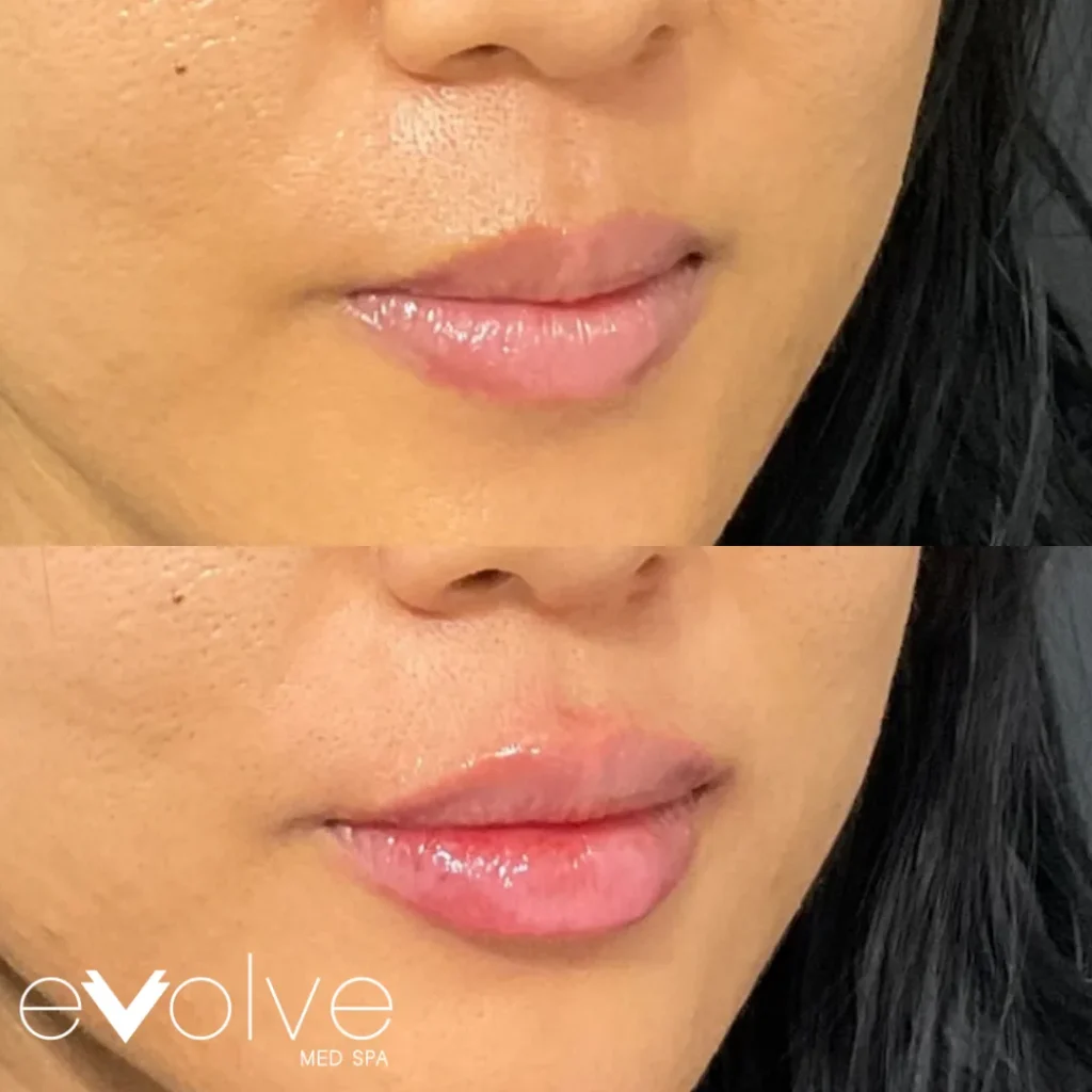 Lip filler before and after with Versa, Evolve Med Spa Bridgewater, NJ, ages 30-40