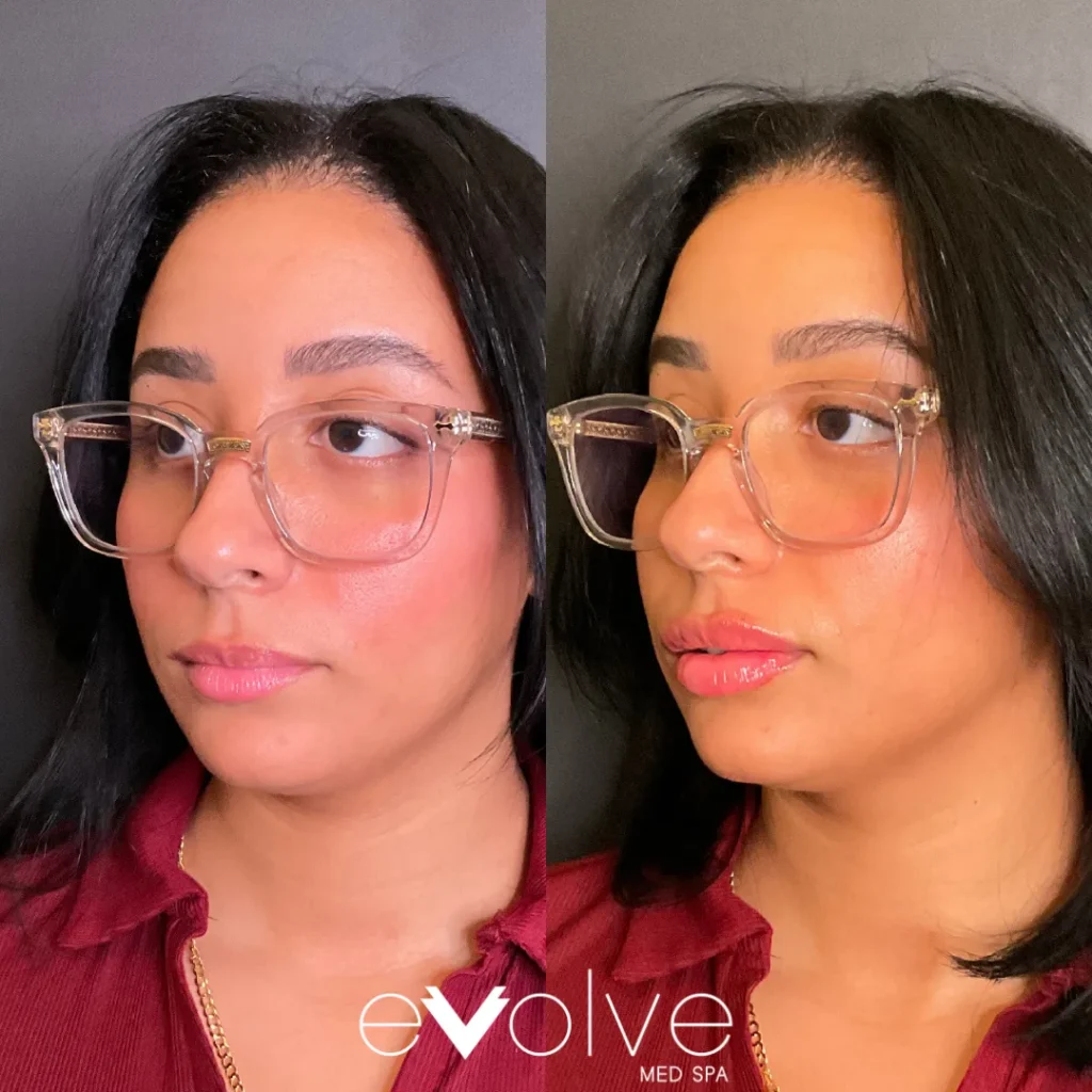 Lip filler before and after with Versa, Evolve Med Spa Denville, NJ, ages 20-30