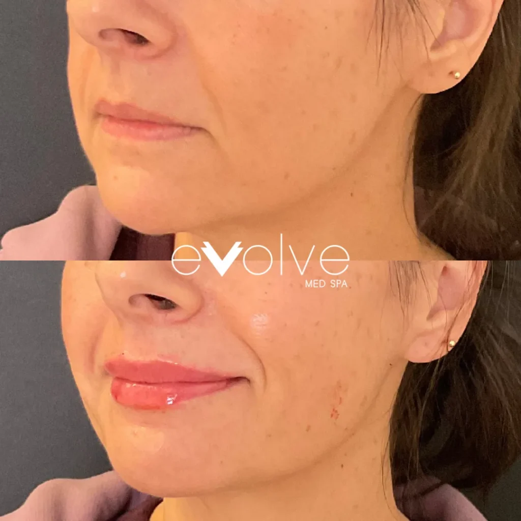Lip filler before and after with Versa, Evolve Med Spa Denville, NJ, ages 40-50