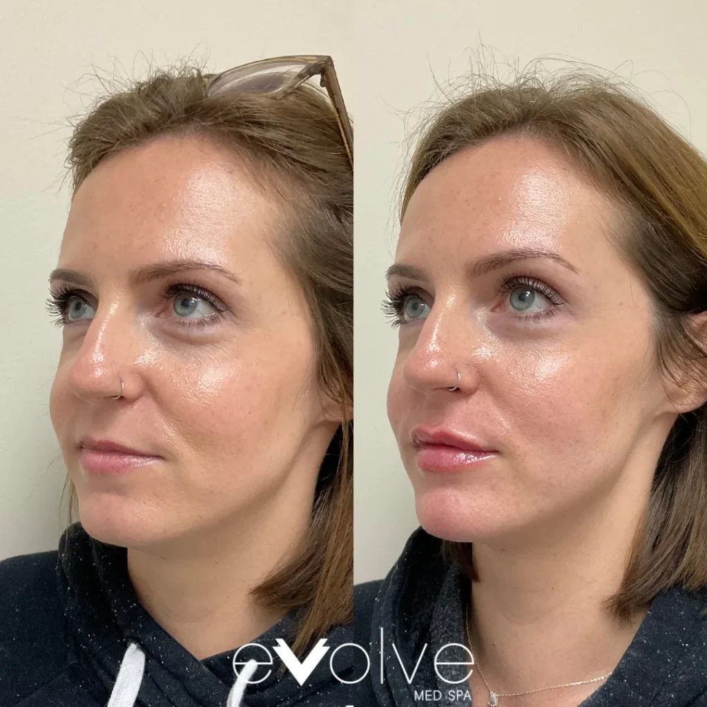 Lip filler before and after with Versa, Evolve Med Spa Frederick, MD, ages 30-40