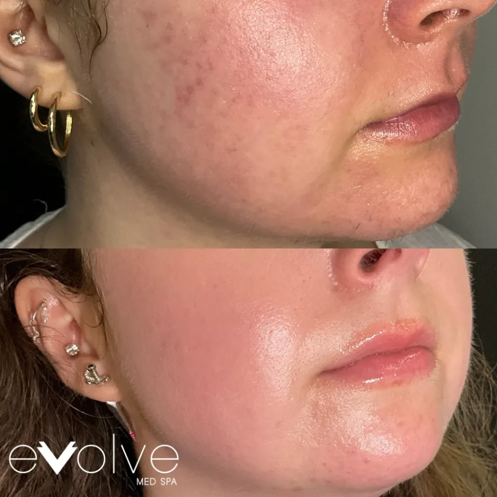 Microneedling before and after for Skin Texture, Evolve Med Spa Hoboken, NJ, ages 20-30