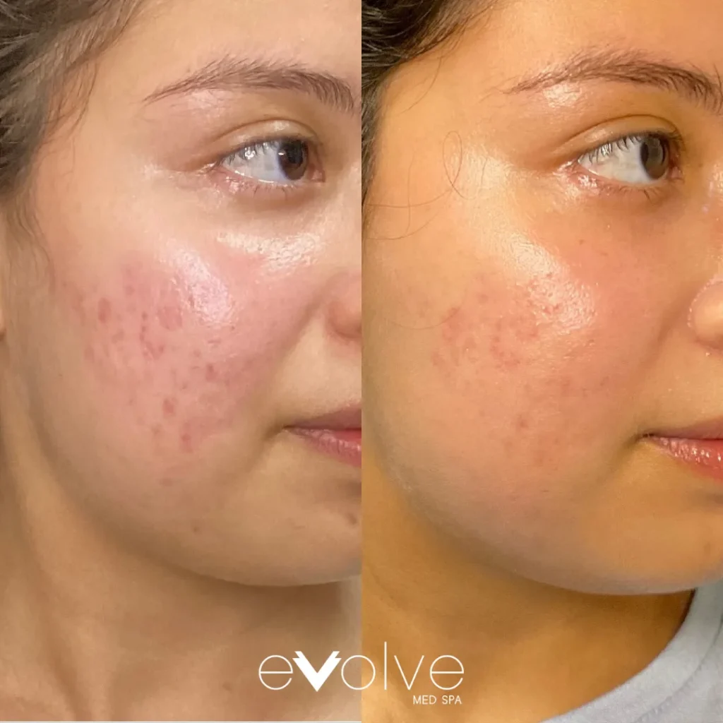Microneedling + PDRN (Salmon DNA) before and after for Scar Reduction, Skin Texture, Evolve Med Spa Hoboken, NJ, ages 20-30