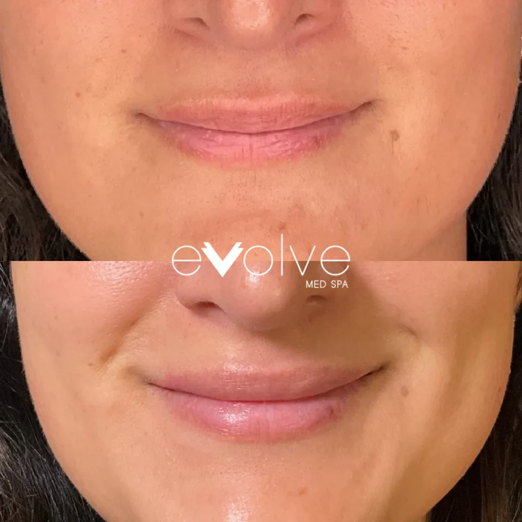 Lip filler before and after with Restylane Kysse, Evolve Med Spa Hoboken, NJ, ages 30-40