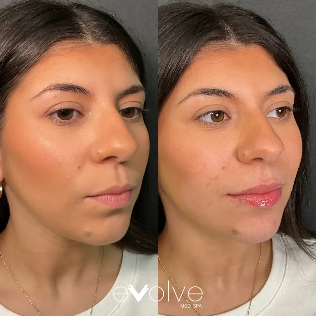 Lip filler before and after with Versa, Evolve Med Spa Hoboken, NJ, ages 20-30