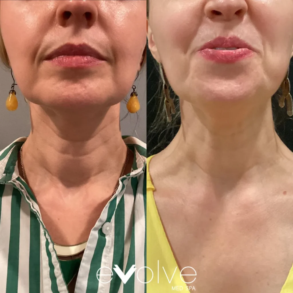 Microneedling before and after for Fine Lines & Wrinkles, Evolve Med Spa Jersey City, NJ, ages 40-50