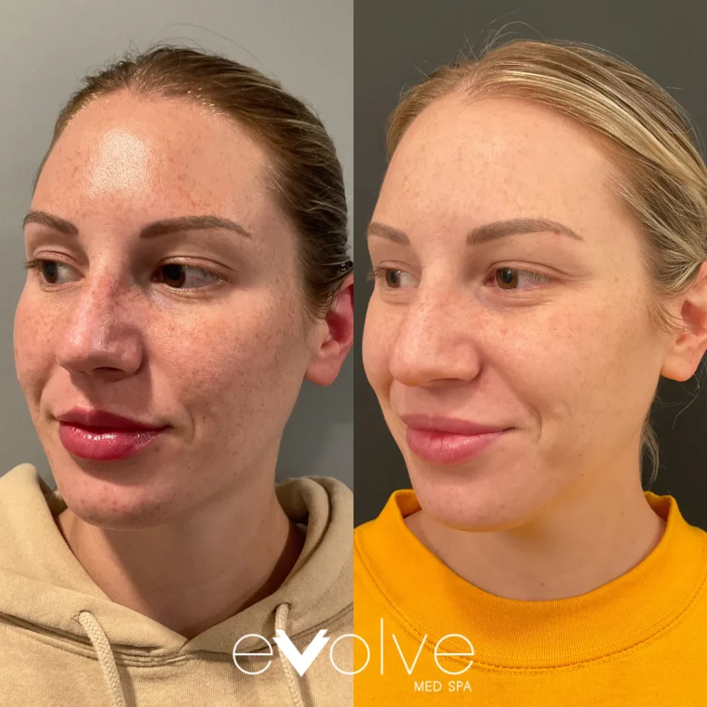 Microneedling before and after for Hyperpigmentation & Sun Spots, Evolve Med Spa Jersey City, NJ, ages 30-40