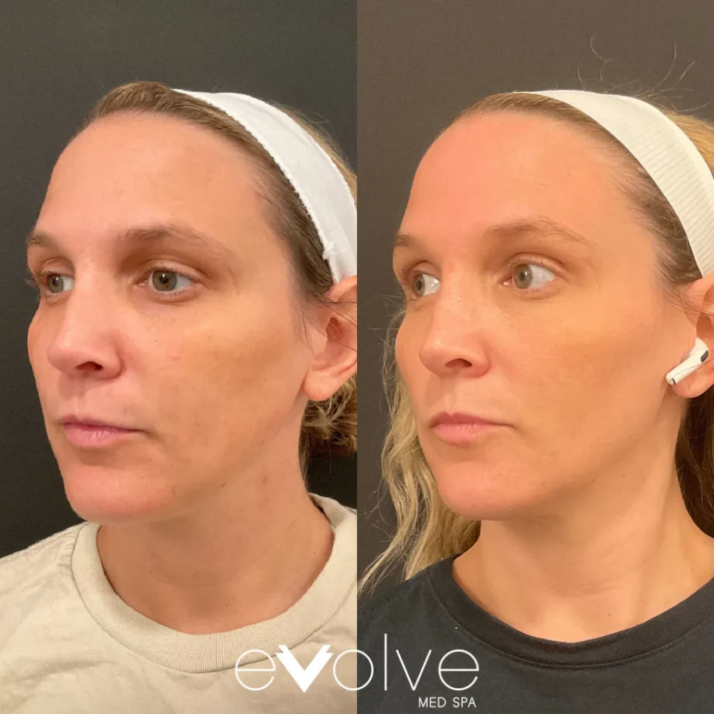 Microneedling + Tox before and after for Fine Lines & Wrinkles, Skin Texture, Evolve Med Spa Jersey City, NJ, ages 30-40