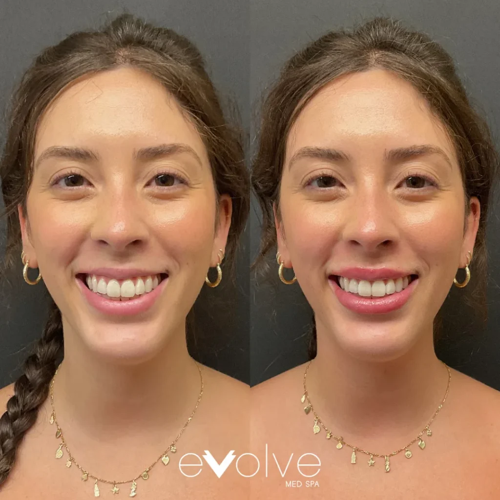 Lip filler before and after with Restylane Refyne, Evolve Med Spa Jersey City, NJ, ages 30-40