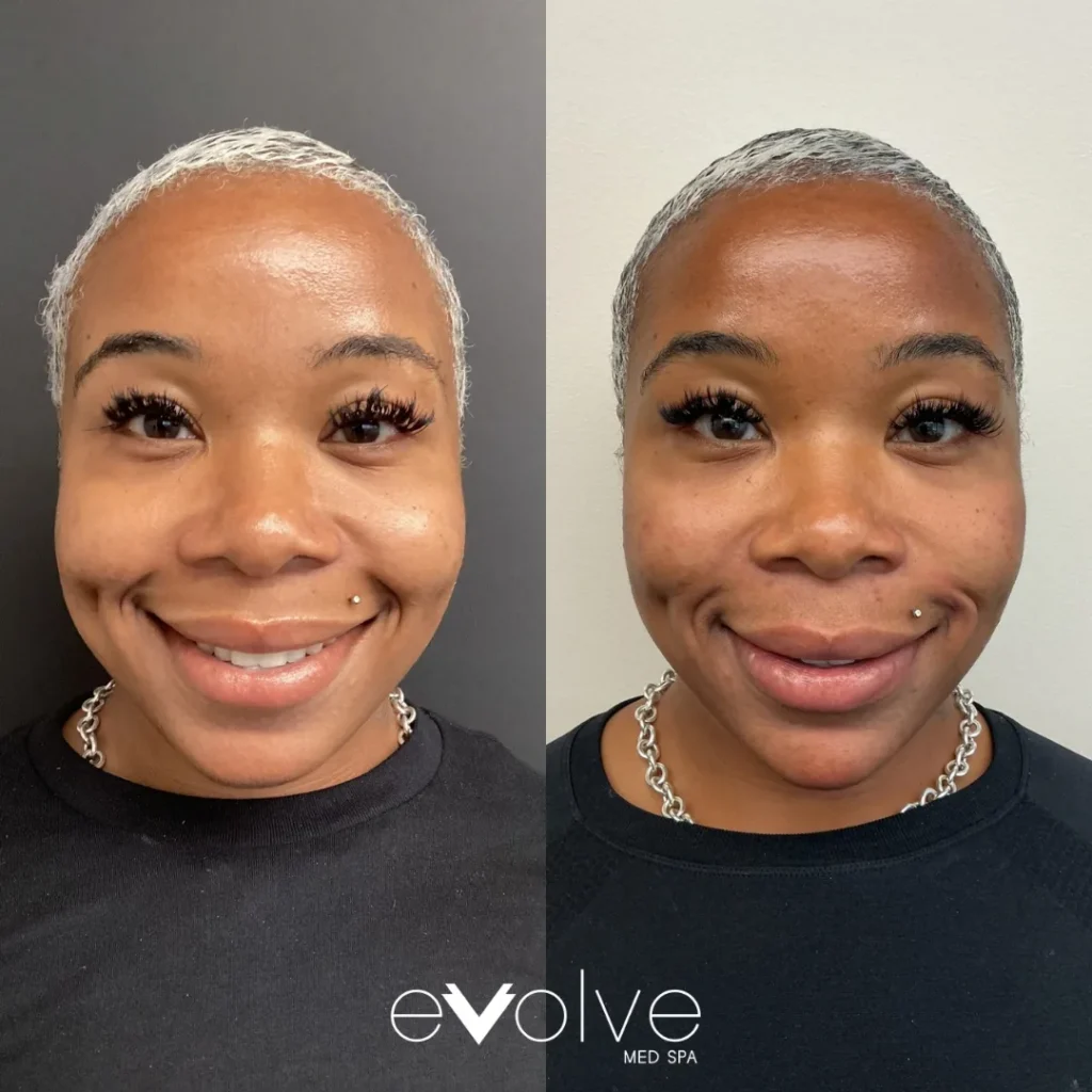 Lip filler before and after with Restylane Refyne, Evolve Med Spa Jersey City, NJ, ages 30-40