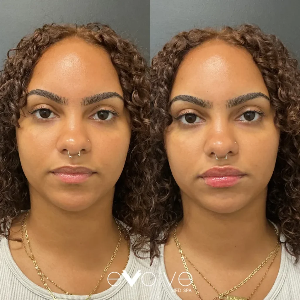 Lip filler before and after with Versa, Evolve Med Spa Lancaster, PA, ages 20-30