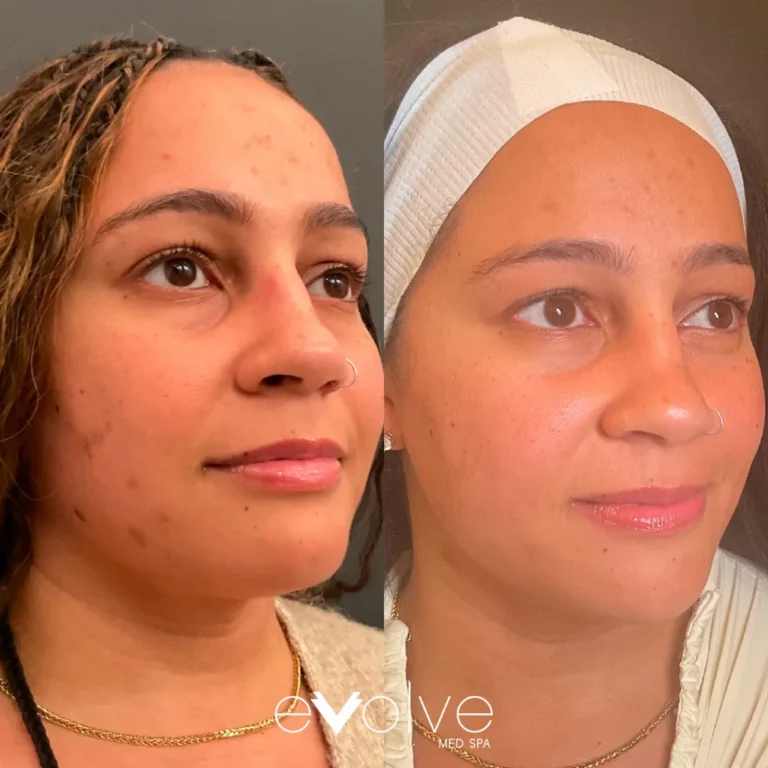 Microneedling before and after — Hyperpigmentation & Sun Spots