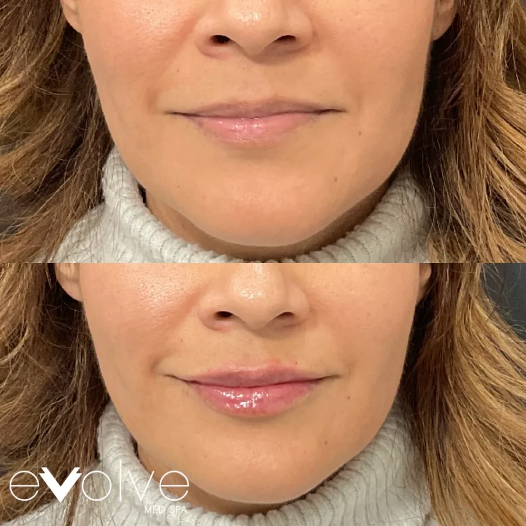 Lip filler before and after with Versa, Evolve Med Spa Old Bridge, NJ, ages 40-50