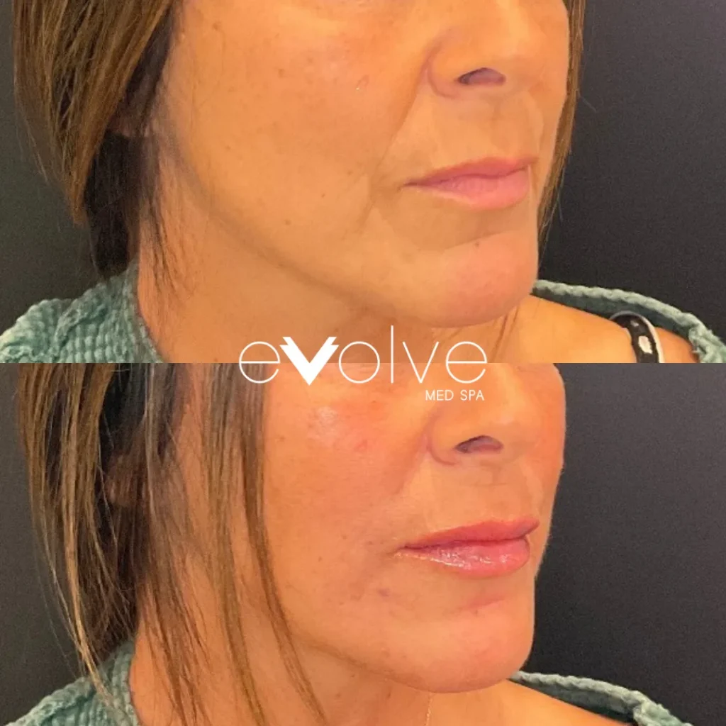 Lip filler before and after with Restylane Kysse, Evolve Med Spa Red Bank, NJ, ages 40-50