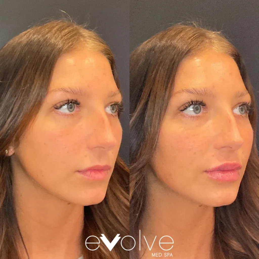 Lip filler before and after with Versa, Evolve Med Spa Red Bank, NJ, ages 20-30
