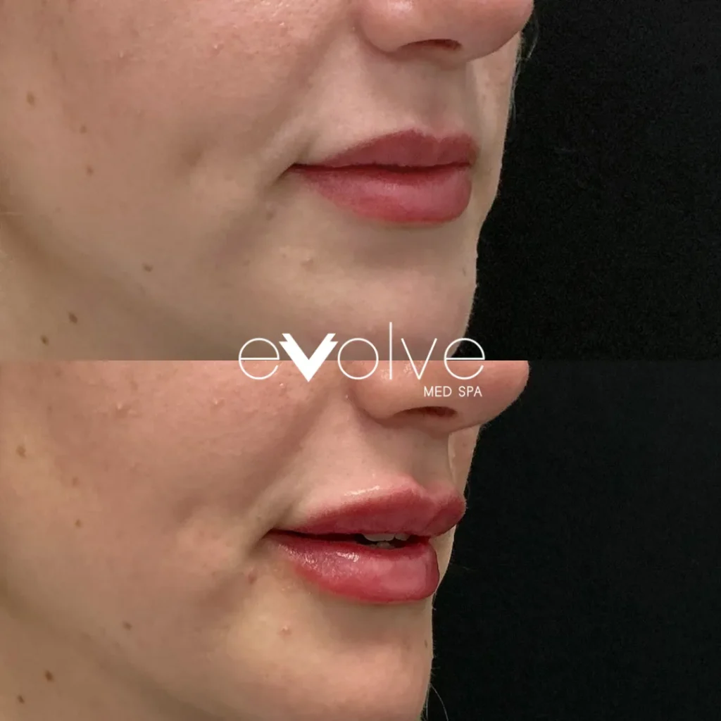 Lip filler before and after with Versa, Evolve Med Spa Short Hills, NJ, ages 30-40