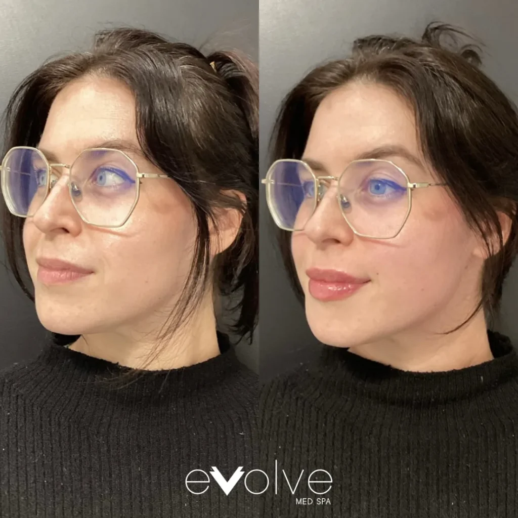 Lip filler before and after with Versa, Evolve Med Spa Short Hills, NJ, ages 30-40