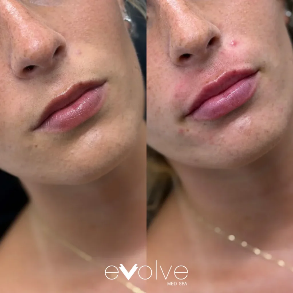 Lip filler before and after with Versa, Evolve Med Spa Tribeca, NY, ages 20-30